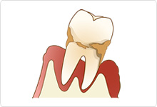 歯周病は予防することができます